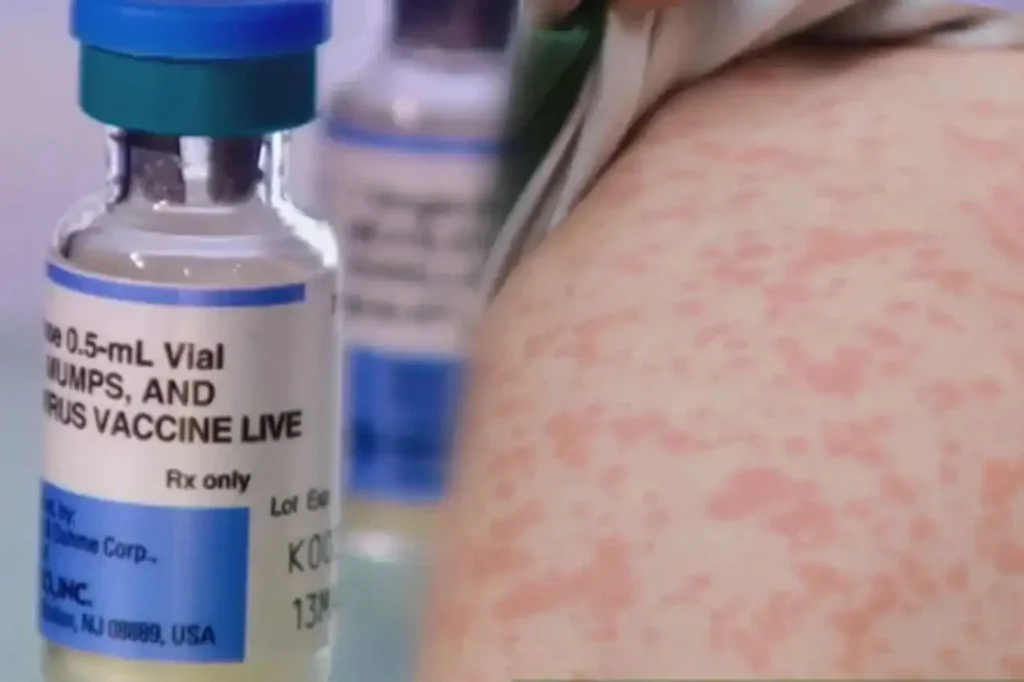 ABD'nin Teksas eyaletinde artan kızamık vakalarının ardından, ilk ölüm vakaları bildirildi.